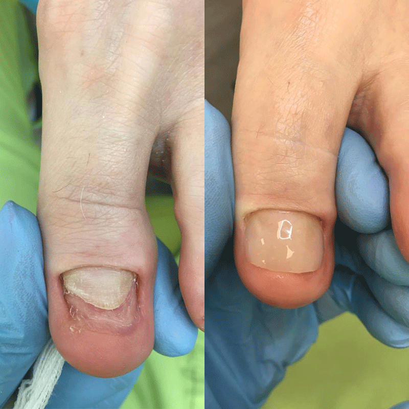 Rekonstrukcja dużego palca u stopy