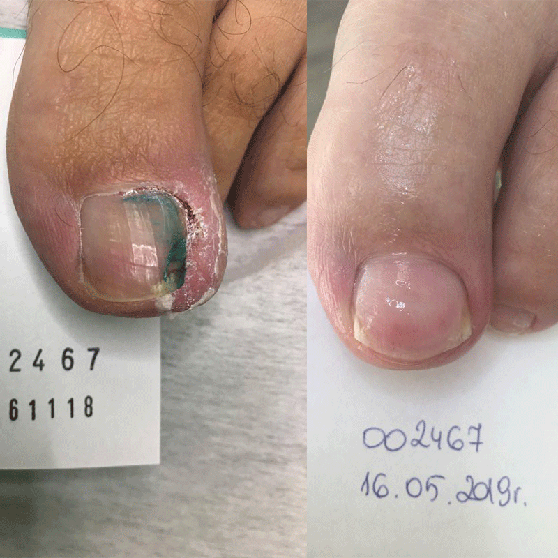 Zabieg na wrastające paznokcie DCZS